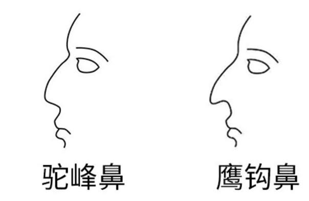 驼峰鼻示意图图片