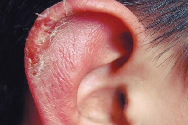 耳朵为什么怕冷?耳朵太薄散热过快(末梢血管血液少)(图2)
