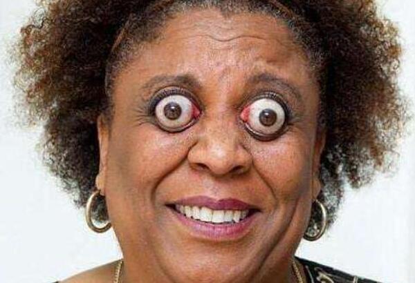 世界上眼球最突出的女人金古德曼眼睛凸出11毫米